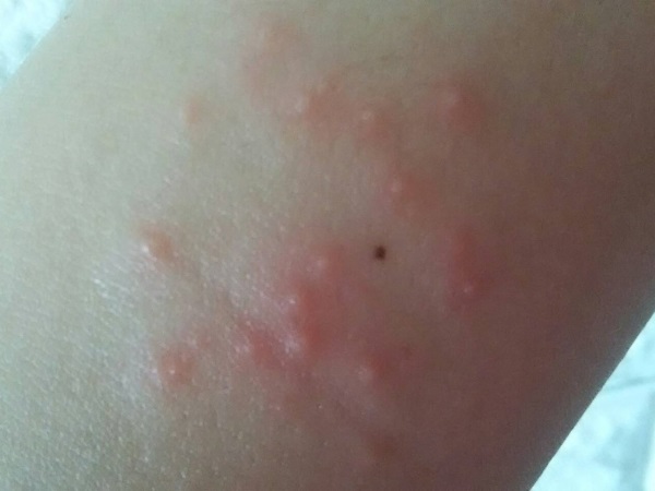 発疹が現れる時期とその様子